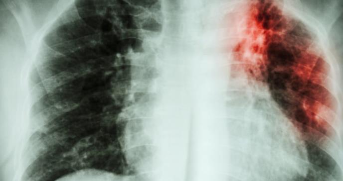 Descubren célula implicada en el desarrollo de fibrosis idiopática pulmonar