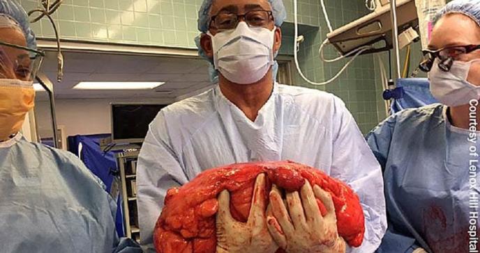 Extirpan tumor de 70 libras que invadió el abdomen de paciente