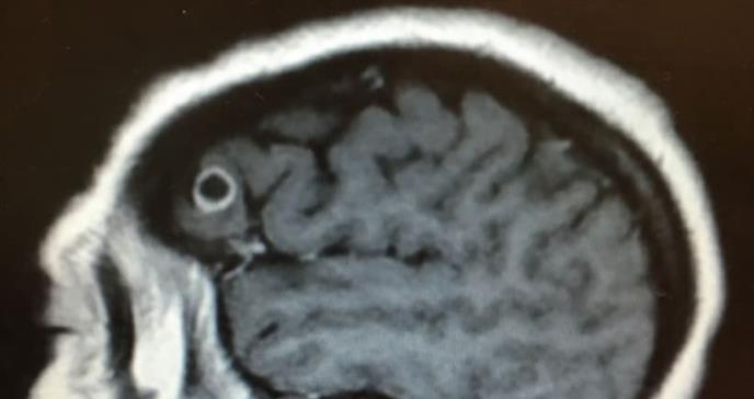 Los médicos abrieron el cráneo de una paciente para eliminar un cáncer y encontraron una tenia
