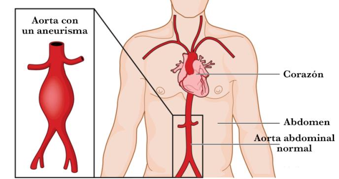Los pacientes con aneurisma aórtico abdominal ven reducida la función cardioprotectora del colesterol HDL