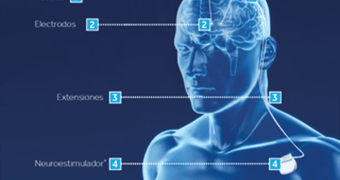 Más del 85% de los pacientes con Parkinson mejoran sus síntomas gracias a la Estimulación Cerebral Profunda