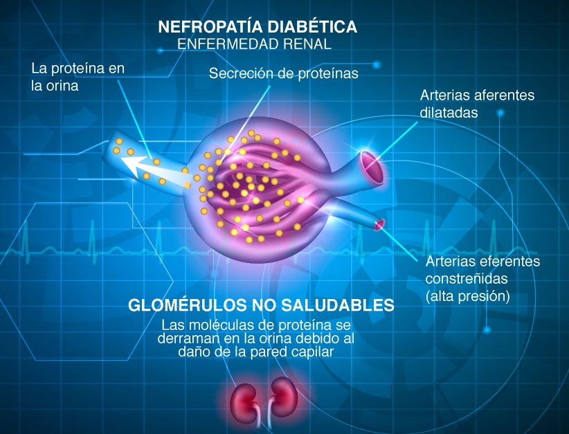 nefropatía diabética)