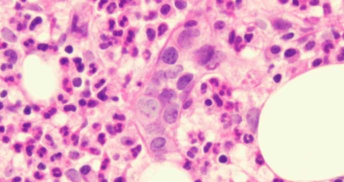 Nanopartícula elimina células cancerosas del linfoma de células B