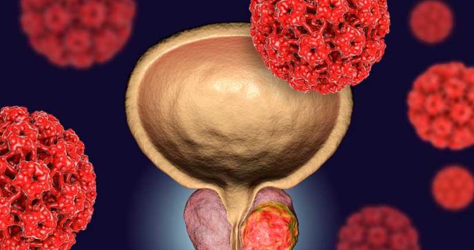 Nueva prueba casera de orina para detectar el cáncer de próstata