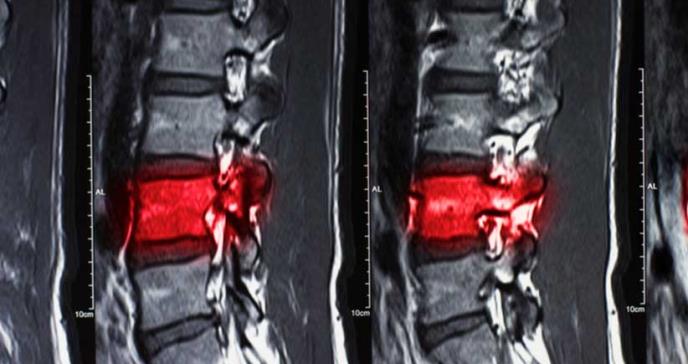 La estimulación de la médula espinal alivia la neuropatía diabética dolorosa