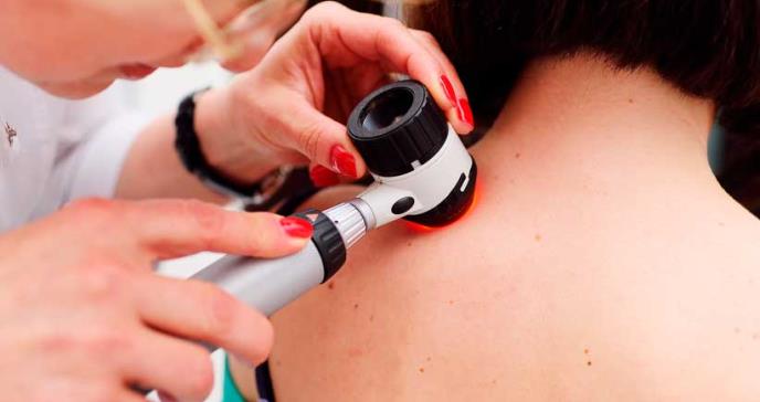 Nueva técnica predice cuáles pacientes con melanoma están en riesgo de metástasis
