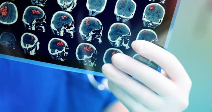 Crean una nueva terapia que podría eliminar el cáncer cerebral