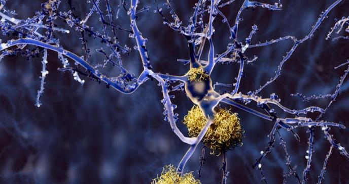 Nuevo biomarcador en sangre permite diagnosticar alzhéimer en estadios tempranos