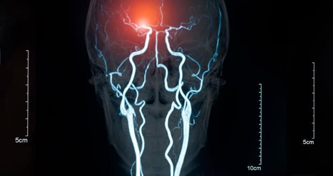 Marcapasos cerebral para pacientes con alzhéimer frenaría el deterioro cognitivo