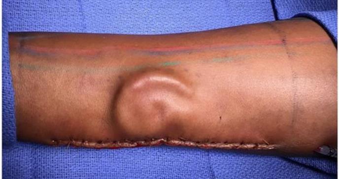 Cirujanos reimplantan oído que creció en el brazo de una paciente