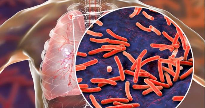 Gran parte de la población mundial tiene riesgo de padecer tuberculosis