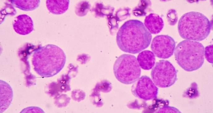 Presentan nuevo mapa mejorado de la leucemia mieloide aguda (LMA)