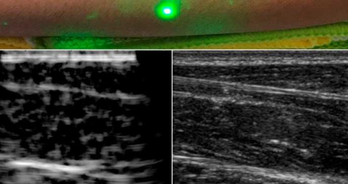 Producen las primeras imágenes de ultrasonido con láser en humanos