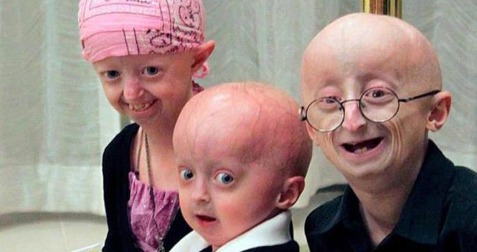 Progeria: el drama de los niños con envejecimiento rápido que viven en promedio 14 años y medio