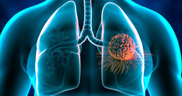 El vínculo desatendido entre tos y cáncer de pulmón