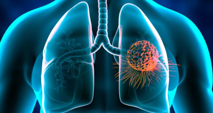 Avances médicos: Terapias biológicas dirigidas al cáncer del pulmón