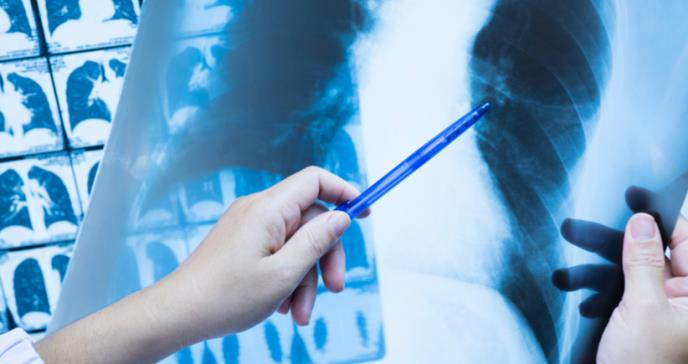 Prevalencia del cáncer de pulmón y múltiples causas