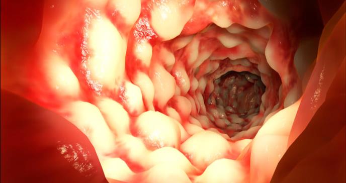 Según la comunidad científica la enfermedad de Crohn se ha vuelto una epidemia internacional