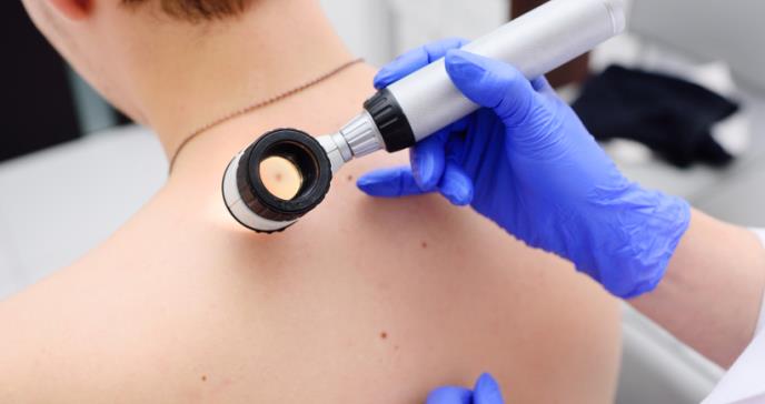 Señales de alarma del melanoma, el cáncer de piel más peligroso