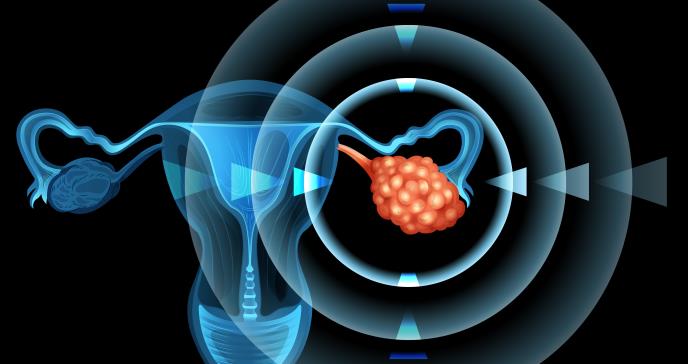 Fármaco logra frenar la progresión del cáncer de ovario recurrente