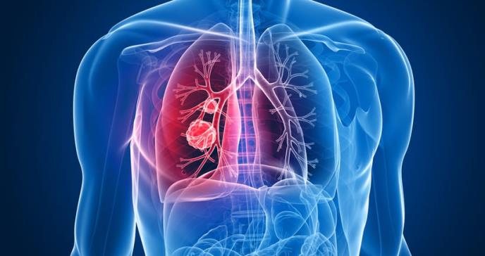 Cáncer de pulmón: ¿quiénes podrían padecer esta enfermedad?