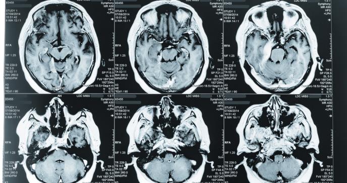 Mayor la tasa de supervivencia de mujeres a los tumores cerebrales no malignos