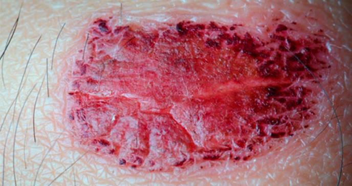 El melanoma no es el único cáncer de piel grave