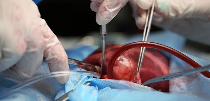 Se realizan los primeros trasplantes de corazón de donantes con hepatitis C