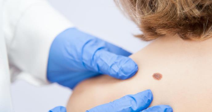 Tratamiento permite que el 52% de pacientes con melanoma avanzado sobreviva al menos 5 años
