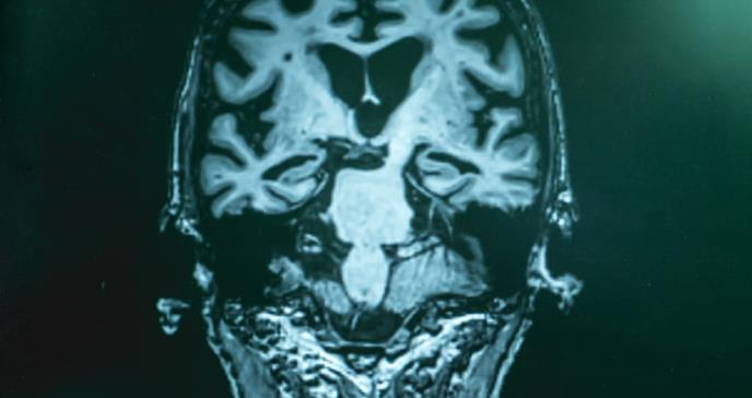 Hallan posible método para restaurar la memoria en afectados con alzhéimer