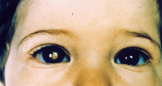 Un fármaco biológico para tratar el cáncer de retina en niños