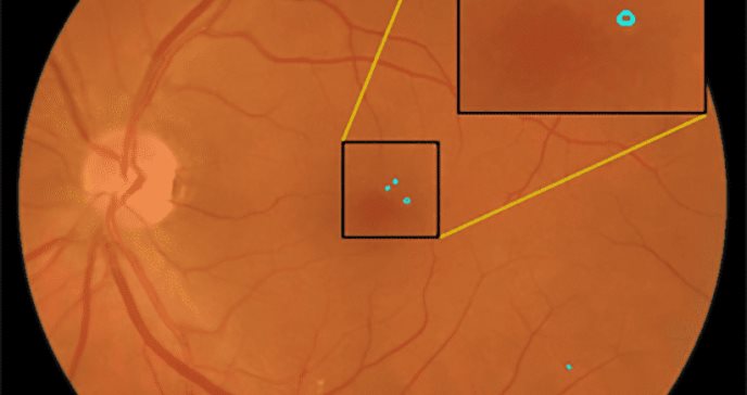 Un sistema automático para detectar lesiones rojas en la retina