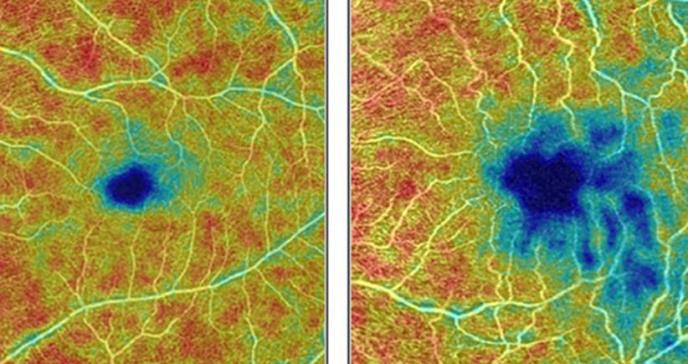 Una exploración del ojo puede detectar precozmente el alzhéimer