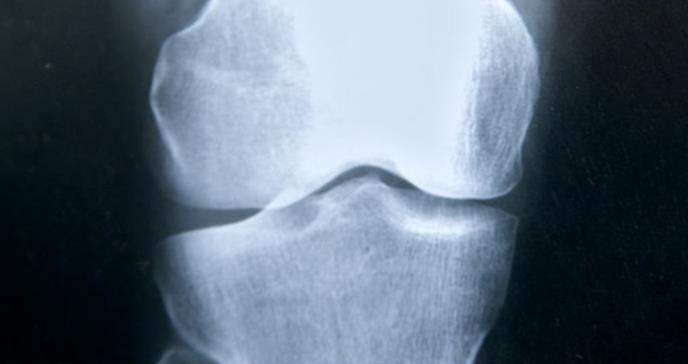 Una mutación predispone a la fractura de fémur en pacientes con osteoporosis