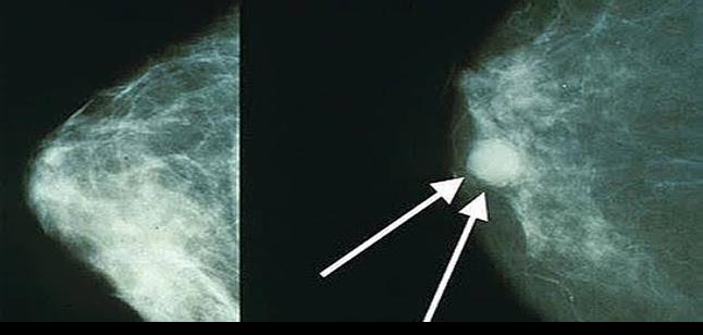 Una prueba permite saber precozmente si el cáncer de mama responderá a la quimioterapia