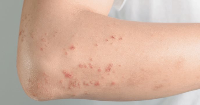 Lesiones en la piel puede ser síntoma de COVID-19 