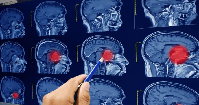 Nueva terapia para tratar los glioblastomas que son tumores cerebrales agresivos