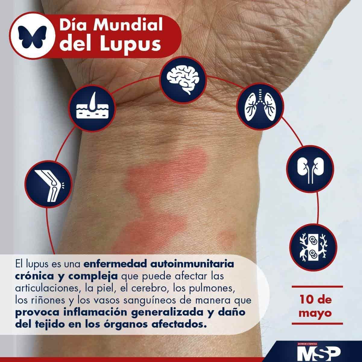 Día Mundial del Lupus