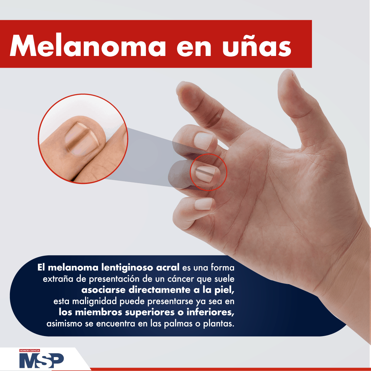 Manicurista descubre melanoma en la uña de una clienta  Sociedad  W Radio  Mexico