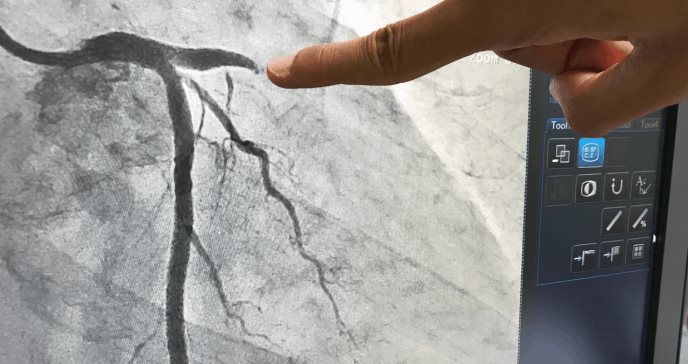 Extraño caso de taquicardia reflejaría enfermedad cardíaca a largo plazo en pacientes con Covid-19