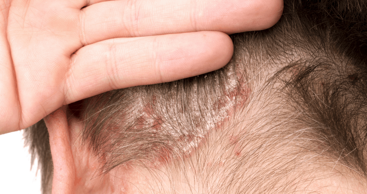 Apoyarse Inconsciente Influencia Psoriasis del cuero cabelludo: síntomas, causas y tratamiento