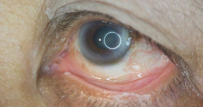La retinopatía diabética es una complicación de la diabetes y una de las causas principales de la ceguera