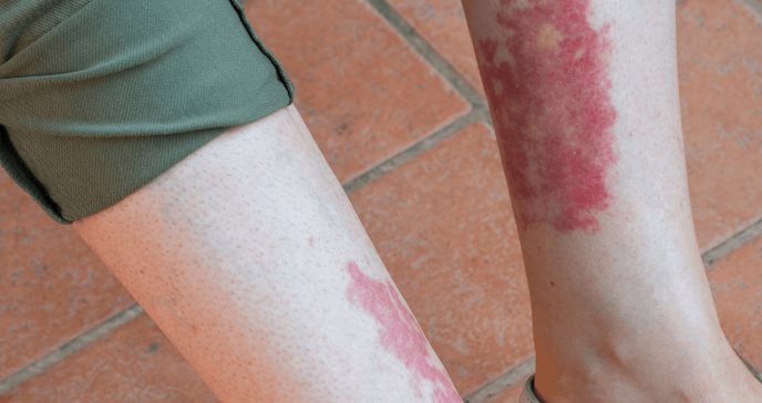 Vasculitis: Nuevas guías para tratar seis formas de la enfermedad