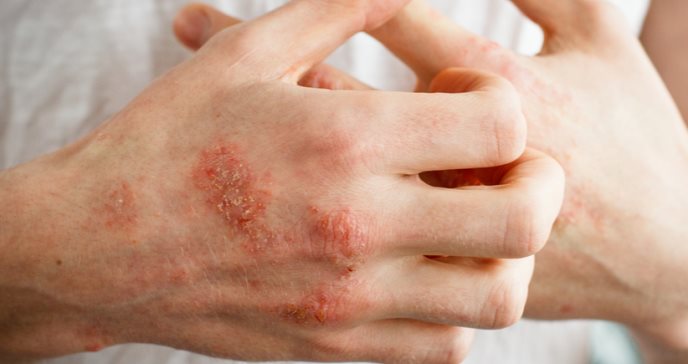 Terapia tópica disminuye efectos de Staphylococcus aureus en dermatitis atópica 