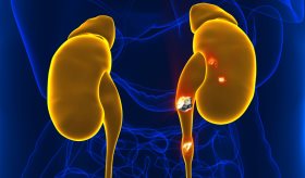 Pacientes con cálculos en el riñón tienen un riesgo mayor de desarrollar síndrome metabólico