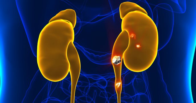 Pacientes con cálculos en el riñón tienen un riesgo mayor de desarrollar síndrome metabólico