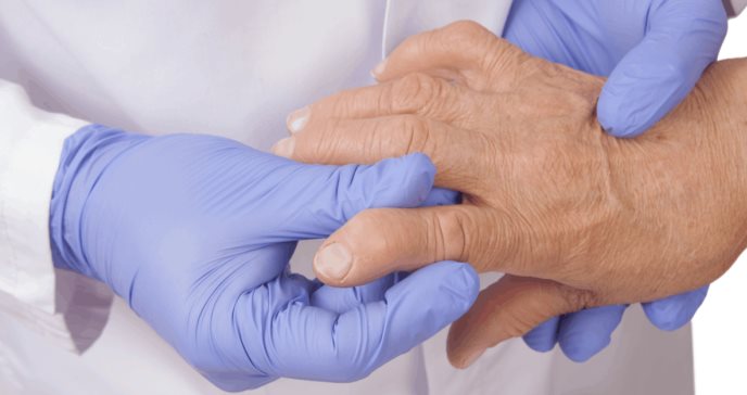 Baricitinib y tofacitinib podrían ser efectivos en tratamiento clínico contra la artritis reumatoide