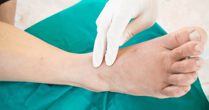 Postergar amputación en la osteomielitis por pie diabético puede empeorar el pronóstico