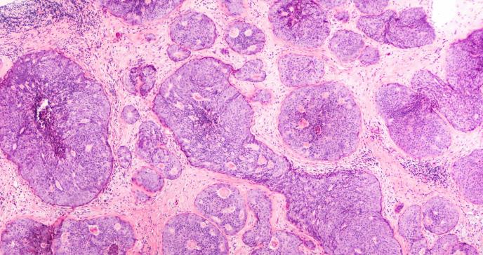 Un ensayo clínico de fase III acerca la cura del cáncer de mama metastásico