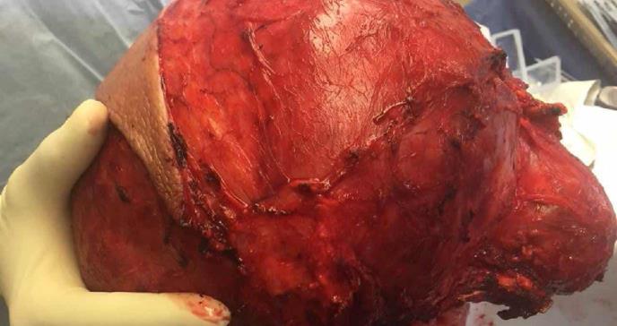 Paciente puertorriqueño desarrolla tumor gigante en el tórax asociado a cáncer de hueso